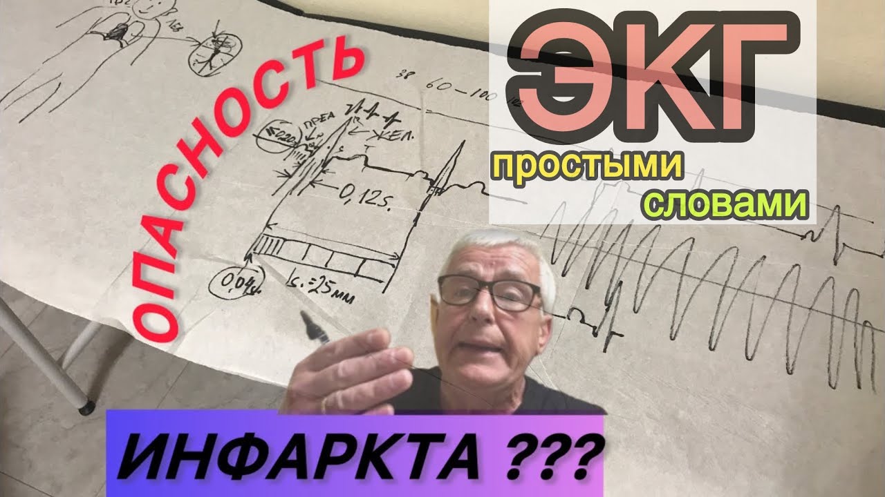 ЭКГ электрокардиограмма простыми словами