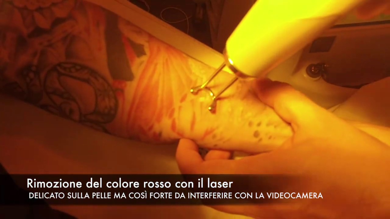 Rimozione tatuaggio con laser PicoSure