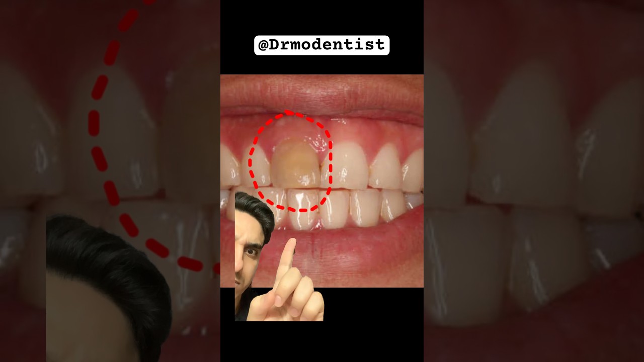 individual upper front tooth discoloration! Dentist reacts #teethwhiteningtips #teethwhiteningremedy