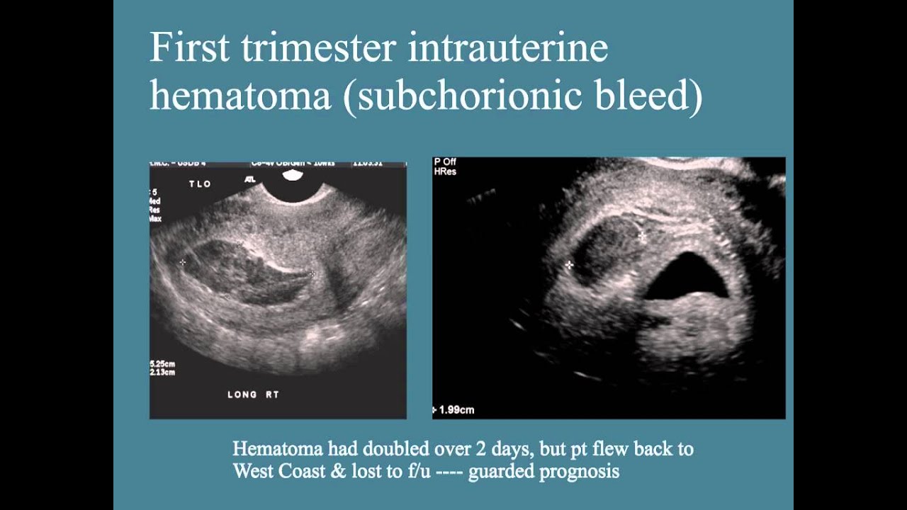 first trimester sonography review
