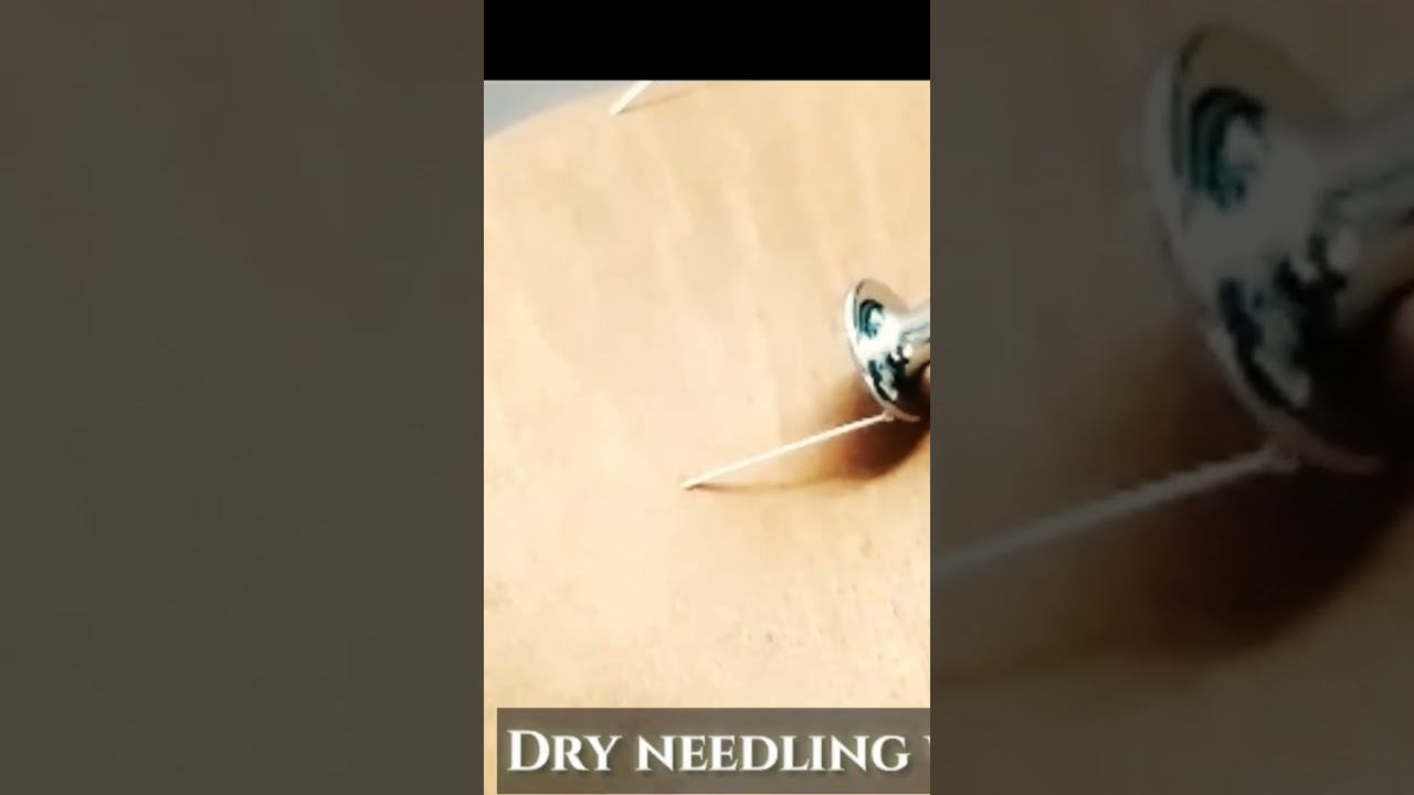 #dryneedling #physio #mumbra #accupuncture #thane #education #backpain #arthritis #healing #drsrk