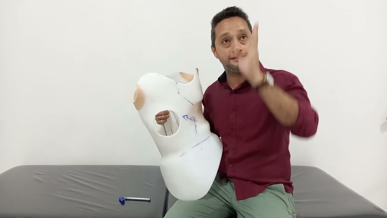 Colete de Chêneau 3D para escoliose #escoliose #escoliosis