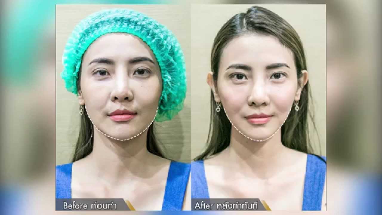 รีวิว ประสบการณ์  ร้อยไหมหน้าเรียว 4D Stem cell ที่ THEKLINIQUE