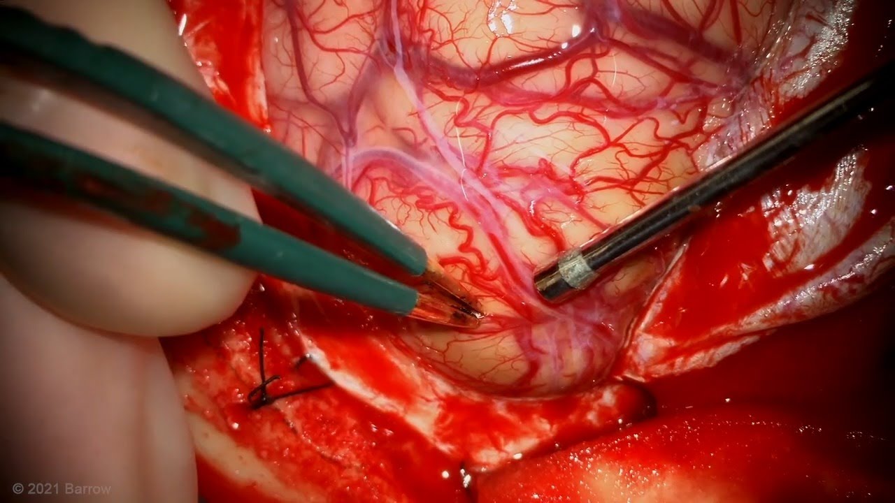 Microsurgical Resection of a Paramedian Parietal Arteriovenous Malformation