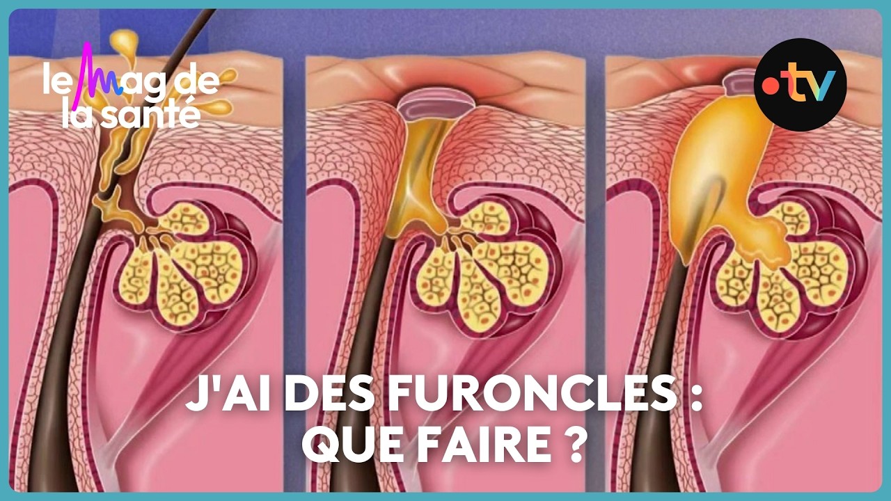 Furoncles : que faire en cas d'infection à staphylocoque doré ?