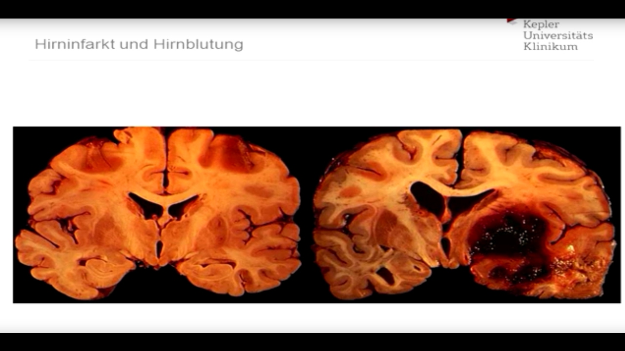 Was passiert beim Schlaganfall? - Mit Prim. Priv.-Doz. Dr. Tim J. von Oertzen