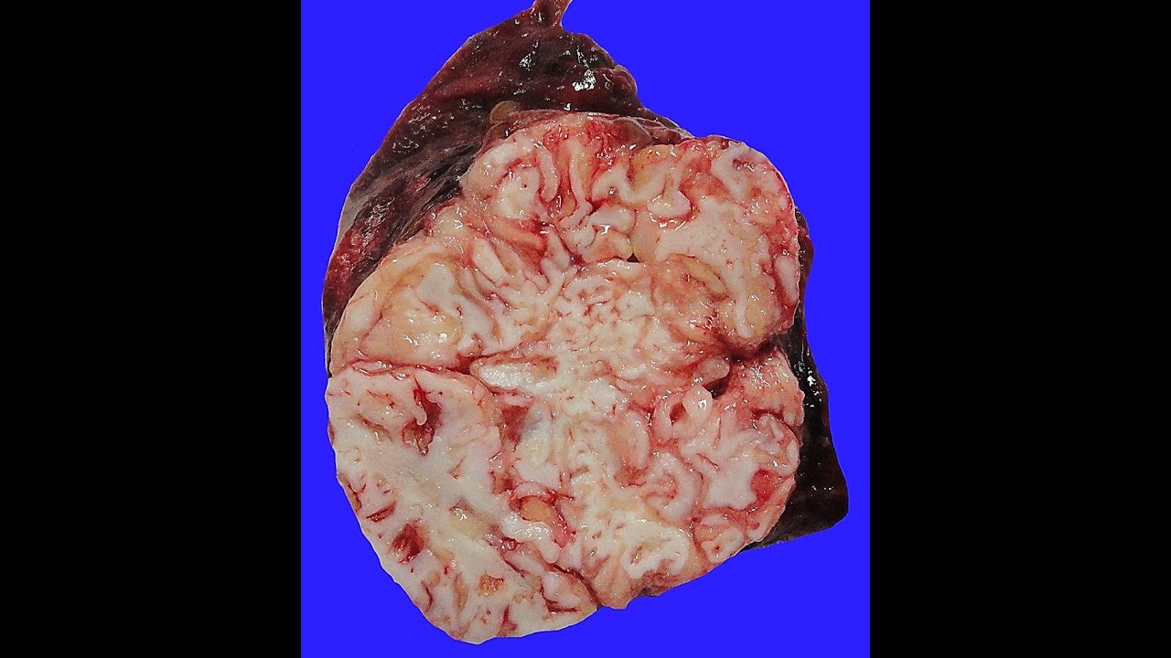 GENERAL PATHOLOGY 50 : embryoma hamartoma choristoma DR SAMEH GHAZY