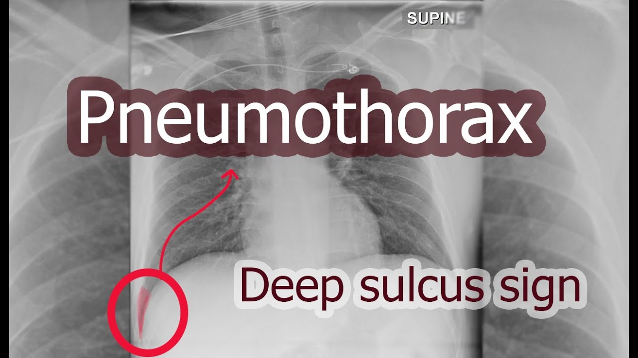 Deep sulcus sign | Pneumothorax in supine position | استرواح الصدر بوضعية الاضطجاع | الثلم العميق