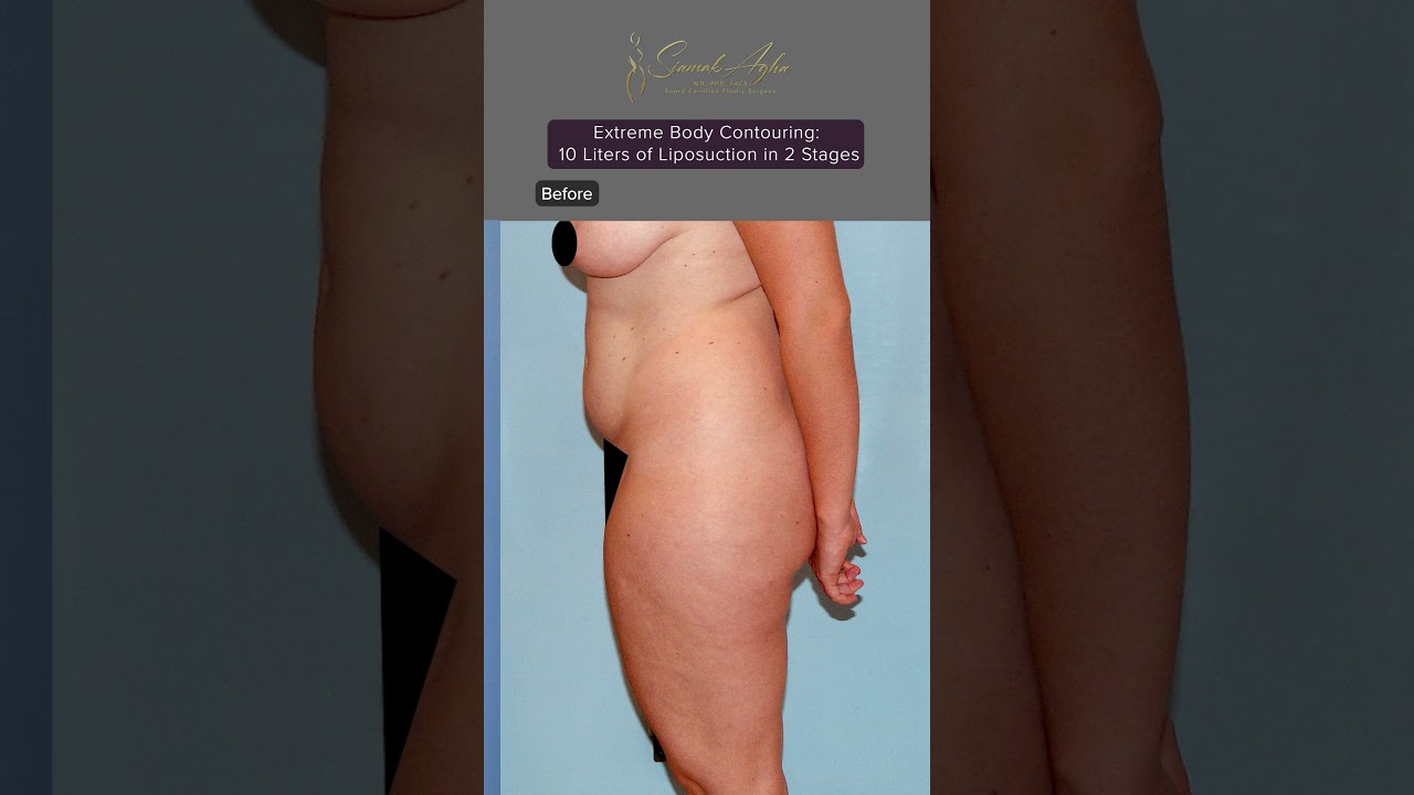 Large Volume Liposuction ✨