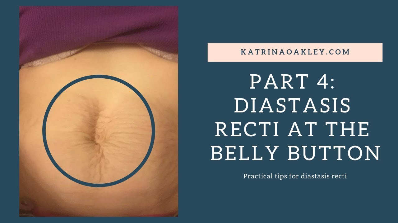 Diastasis Recti at the Belly Button
