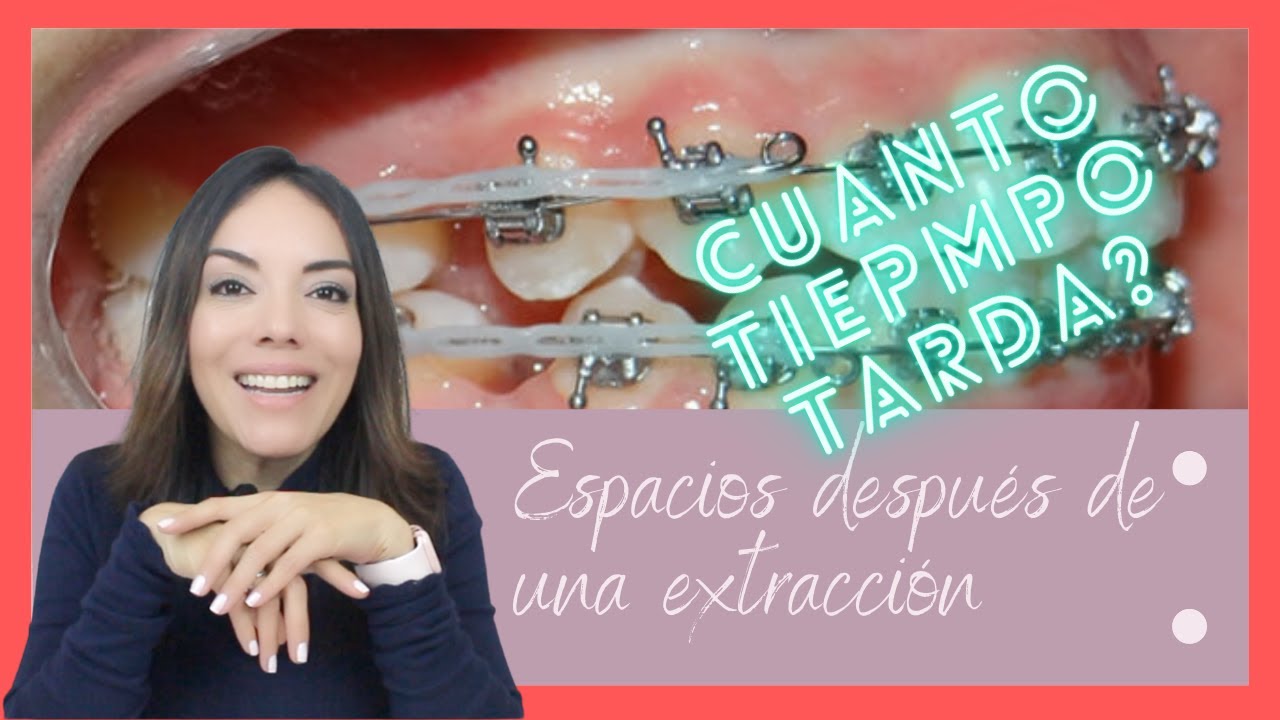 Cuánto tiempo tarda en cerrar un espacio después de extracciones?