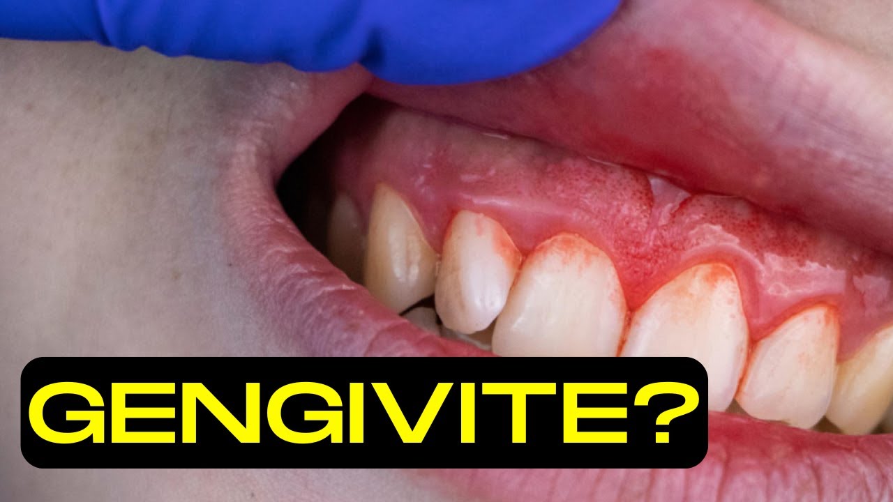Gengive gonfie e sanguinanti? Ti svelo i rimedi efficaci #farmacista #salute #benessere #consigli
