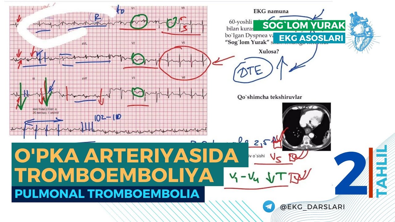 = EKG Tahlili-02 = O'pka Arteriyasida Tromboemboliya = Pulmonal Tromboembolia =