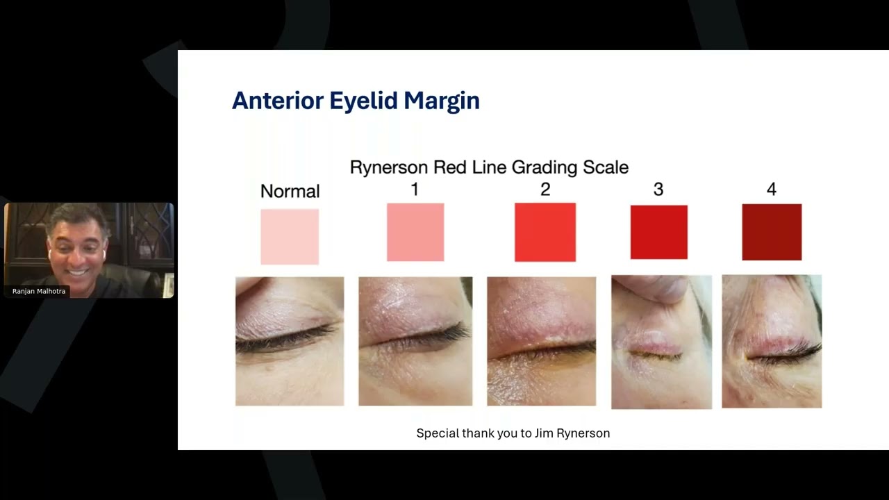 Dry Eye Disease in Cataract Surgery: A Case-Based Discussion - Drs. Mile Brujic and Ranjan Malhotra
