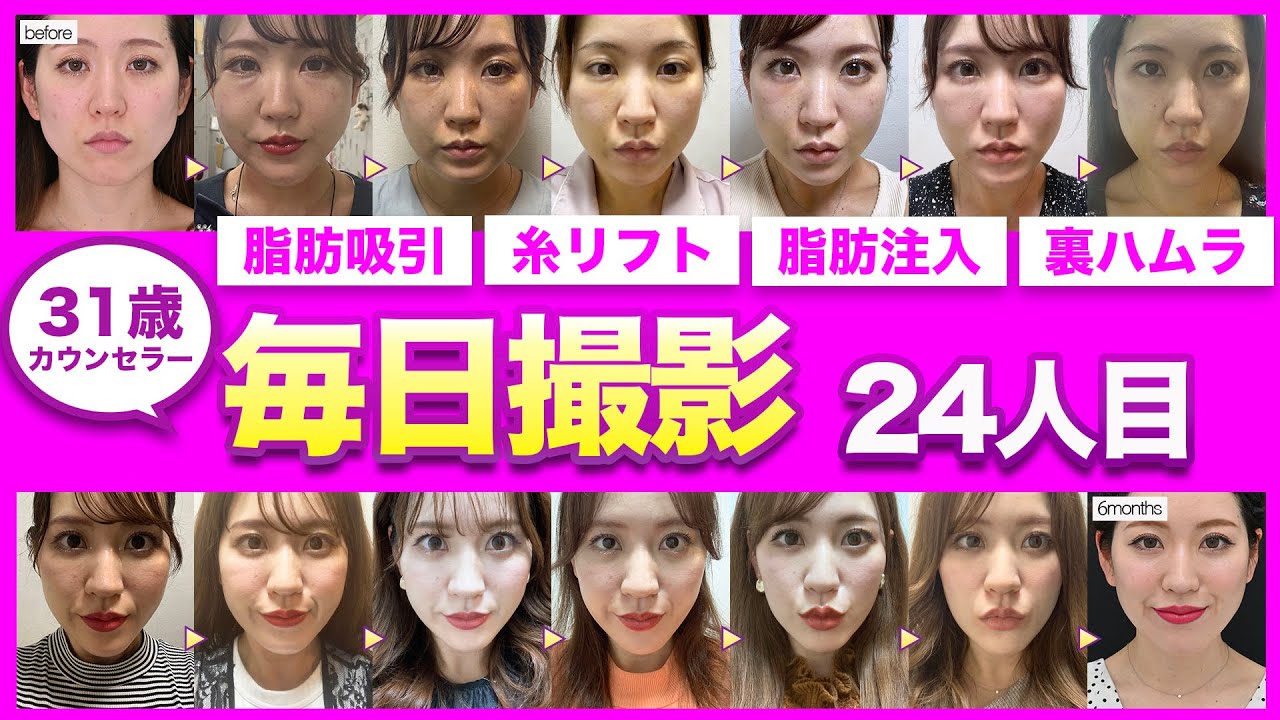 【脂肪吸引ダウンタイム】「フェイスラインの凸凹・頬のもたつき・目の下のクマが気になる」31歳女性の小顔整形ダウンタイムに密着【顔の脂肪吸引・糸リフト・クマ取り】