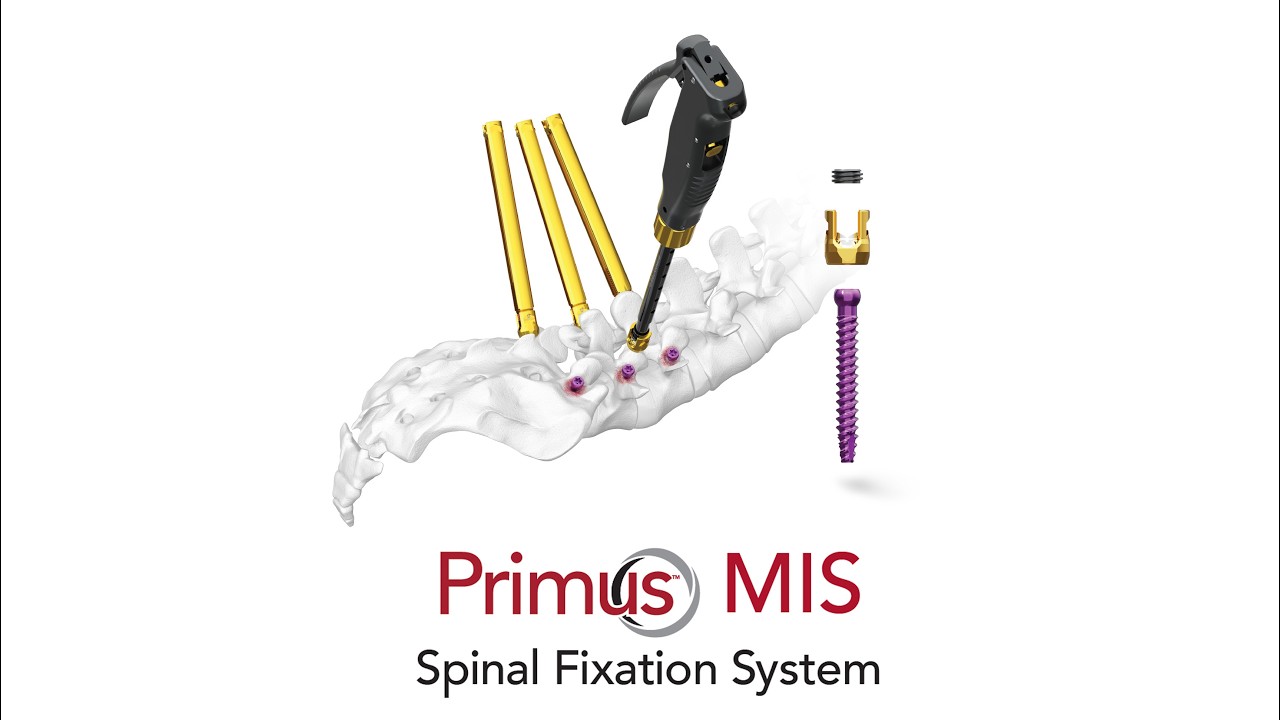 Primus® MIS: Surgical Demonstration of a Versatile and Efficient Modular Pedicle Screw System