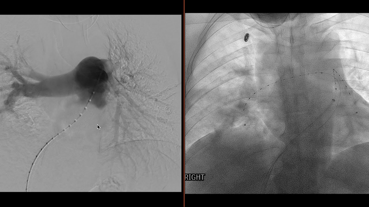 Case Discussion: IR Catheter Directed Thrombolysis For High PE Burden