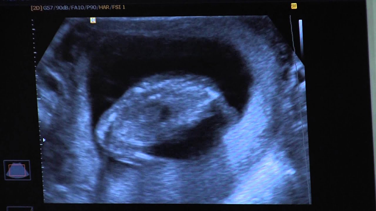 TV2 Babavil&aacute;g - KRIO Int&eacute;zet Zrt. - Ultrahang &ndash; Mi t&ouml;rt&eacute;nik a 23- h&eacute;ten?