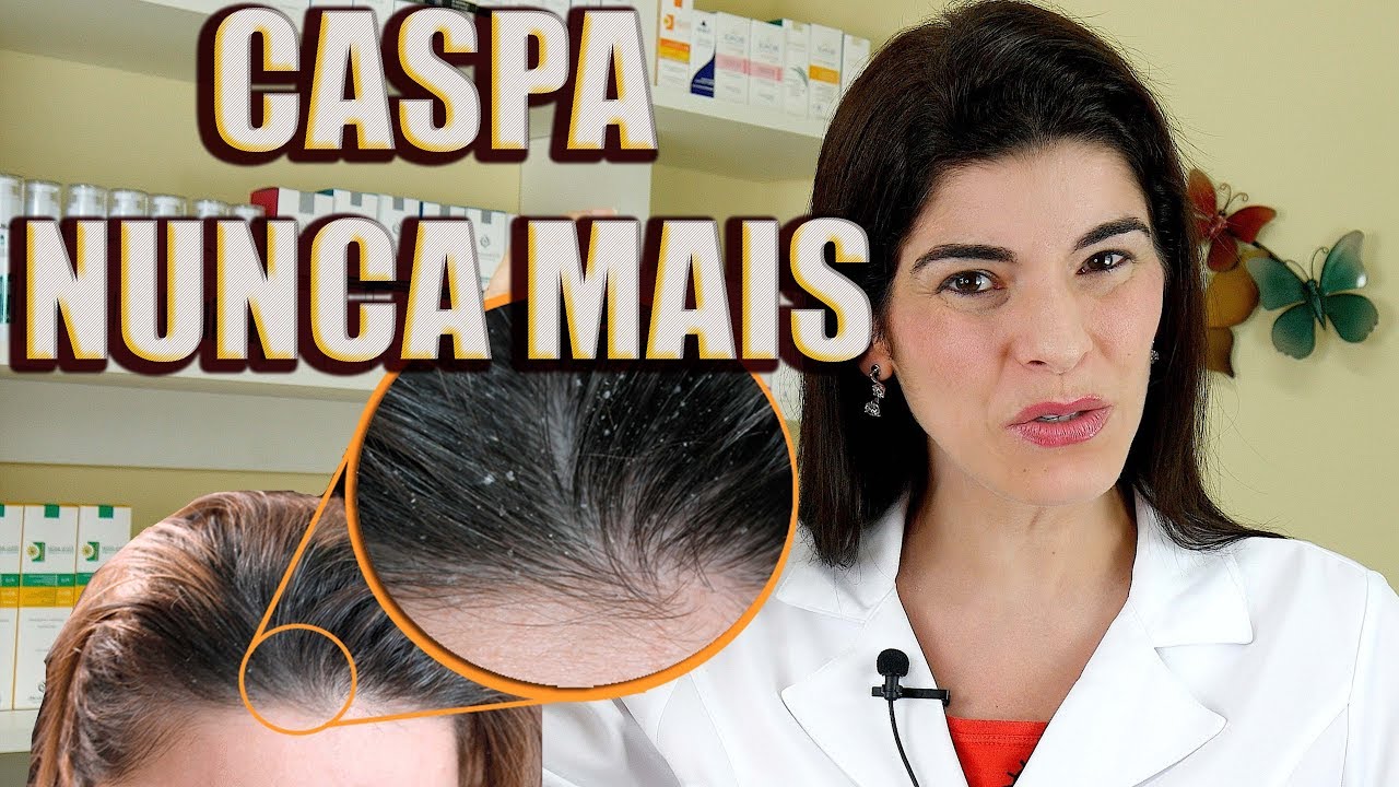 CASPA NUNCA MAIS - Acabe com a Caspa de Forma Eficaz !!!