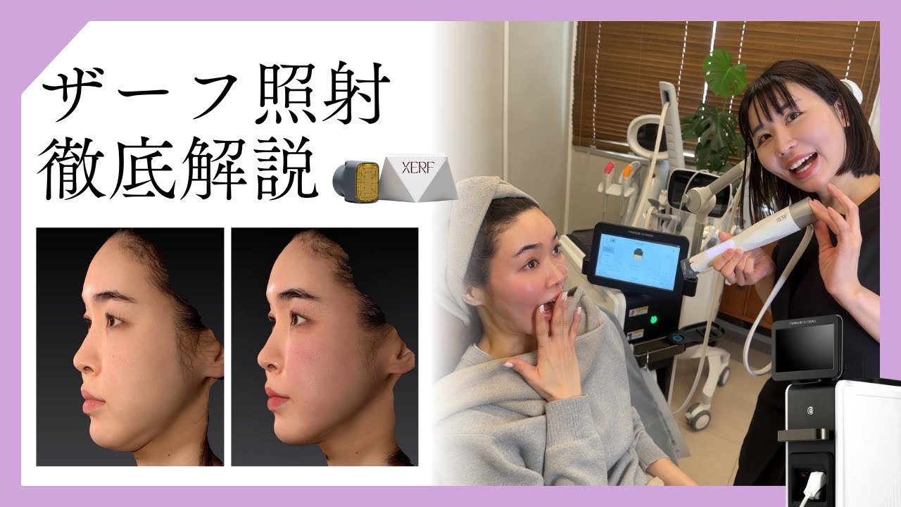 最新たるみ治療｜ザーフ徹底解説！