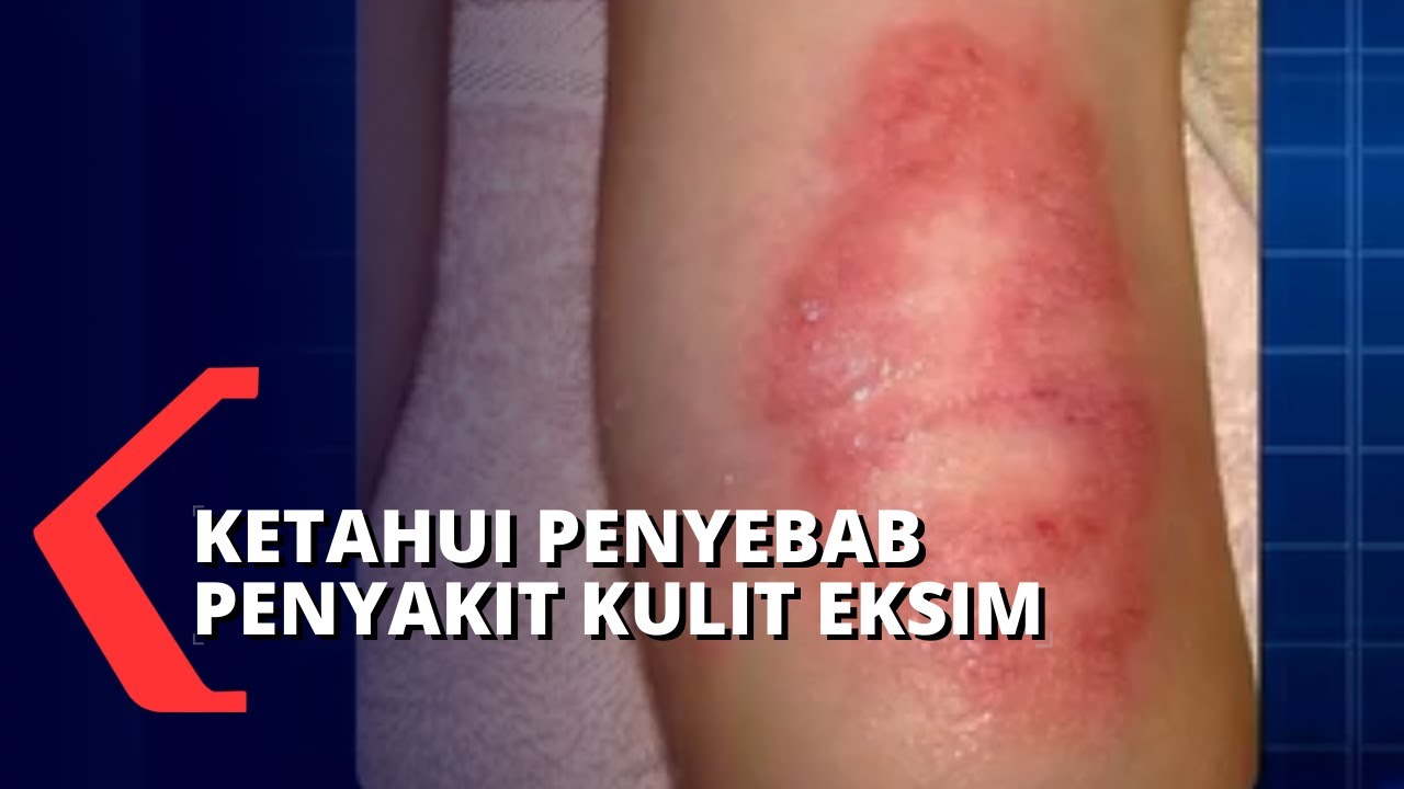 Cara Mencegah Penyakit Kulit Dermatitis Atopik atau Eksim