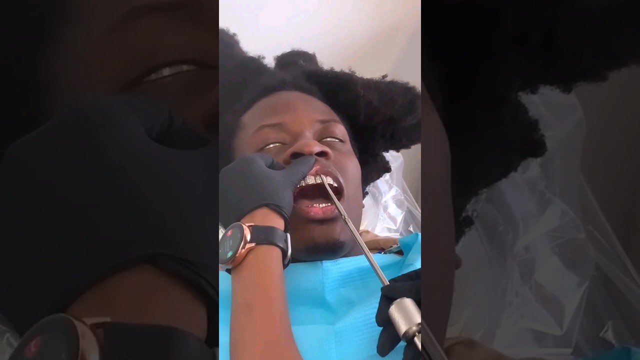 Ouch! Would you be  willing to go through this to remove your permanent #grillz ? #smile