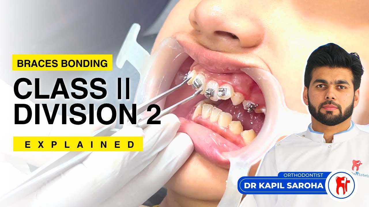Why Class II Div 2 Malocclusion Cases Are So Tricky (Full Bonding Explained)