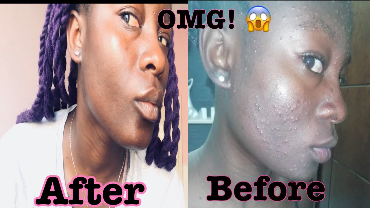 I used Shea Butter on My Skin For 5 Days || How I Got Rid Of My Acne/pimples And Dark Spot