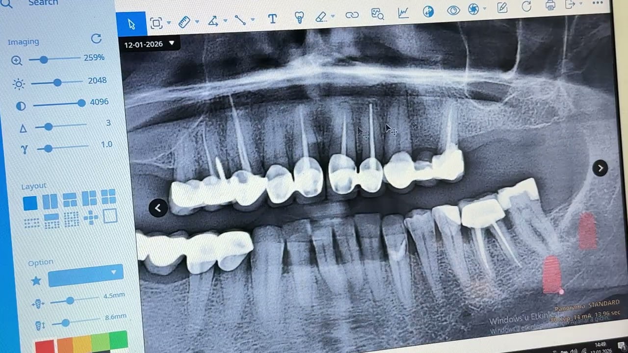 Sinüs Lifting Nedir? Diş İmplant Tedavisinde Sinüs Kaldırma
