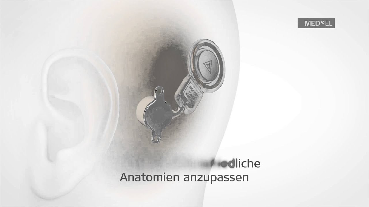Wesentliche Eigenschaften des BONEBRIDGE Implantats