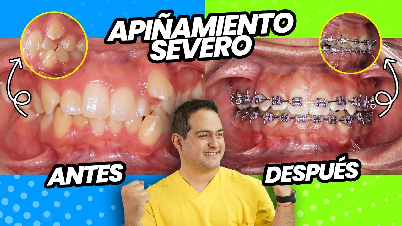 ORTODONCIA CASO REAL con SEVERO APIÑAMIENTO RESUELTO CON BRACKETS ❤️
