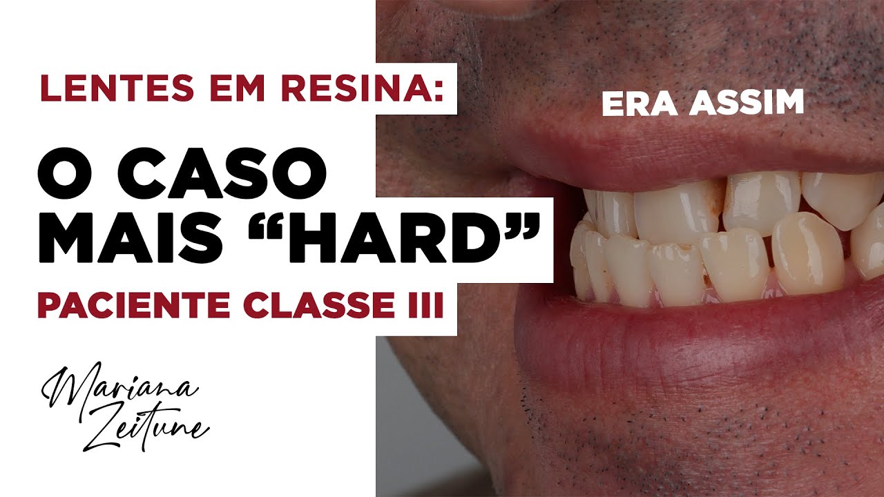 O CASO MAIS COMPLICADO: Facetas em Resina Composta em Paciente Classe 3 - Por Dra. Mariana Zeitune