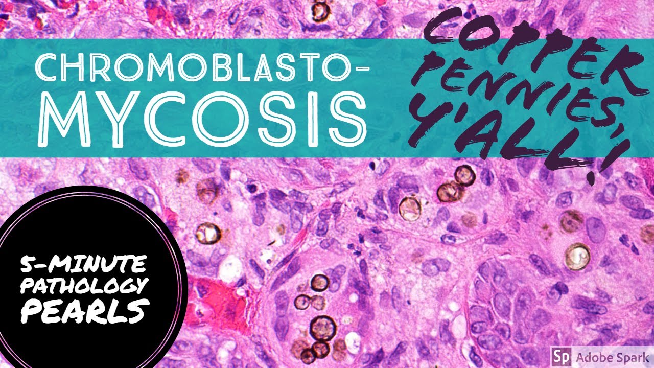 Хромобластомикоз (кожная инфекция, вызванная грибком черной плесени): 5-минутные жемчужины патологии