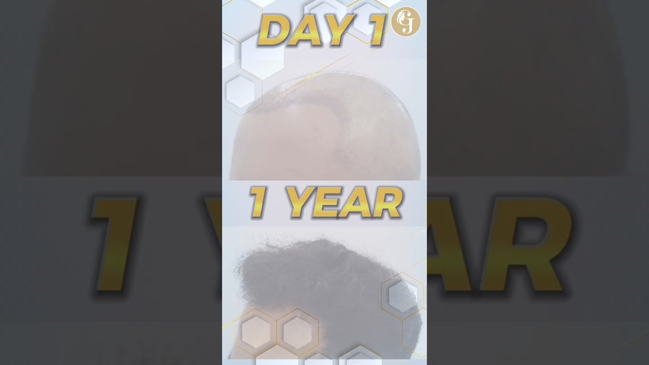 1 Year After SMART FUE  