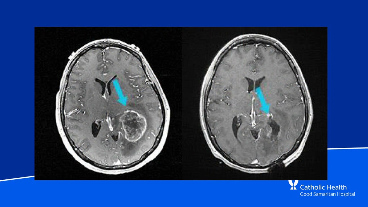 Good Samaritan University: Advances in Neurosurgery