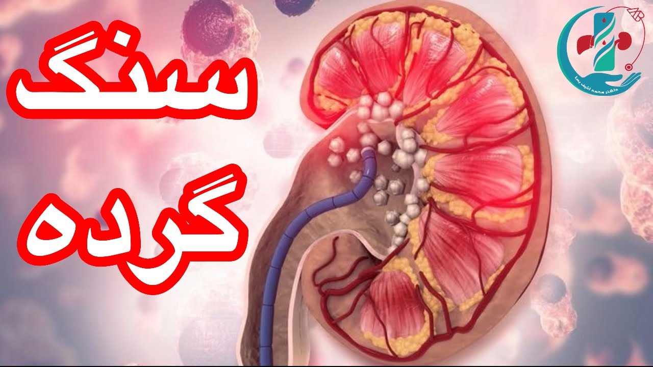 معلومات جامع و جدید در مورد سنگ های گرده.Kidney stone
