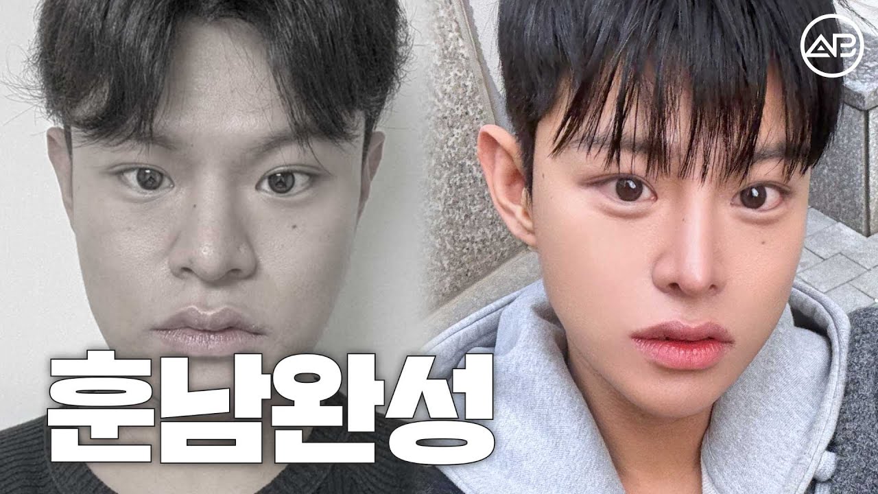 부담스럽지 않은 훈남으로 과거 얼굴 청산 | 후기있음 | 에이비성형외과