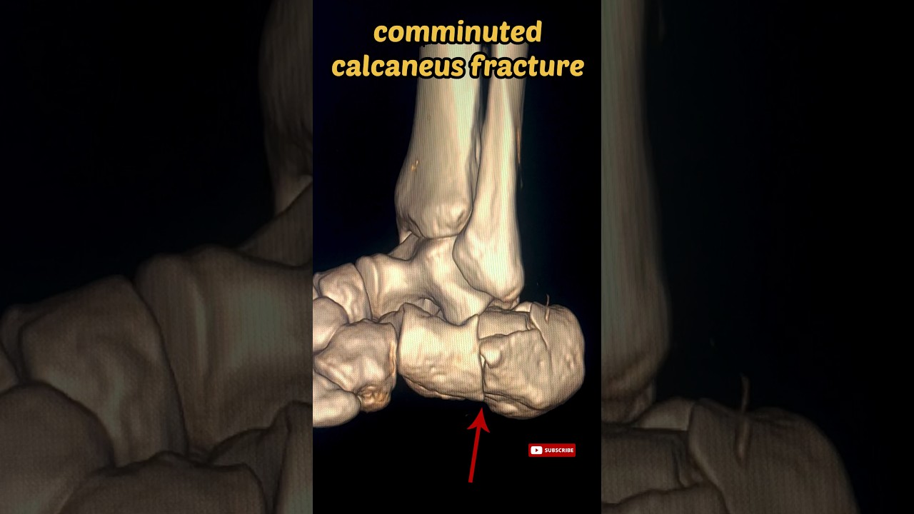 Calcaneus (Heelbone) fracture #fracture #calcaneus #heelbone #anklejoint #shorts