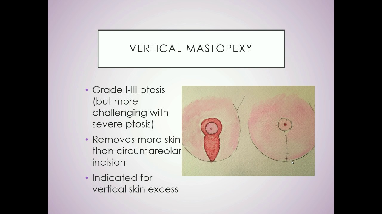 Mastopexy Lecture | Nina S. Naidu, MD FACS - NYC Plastic Surgery