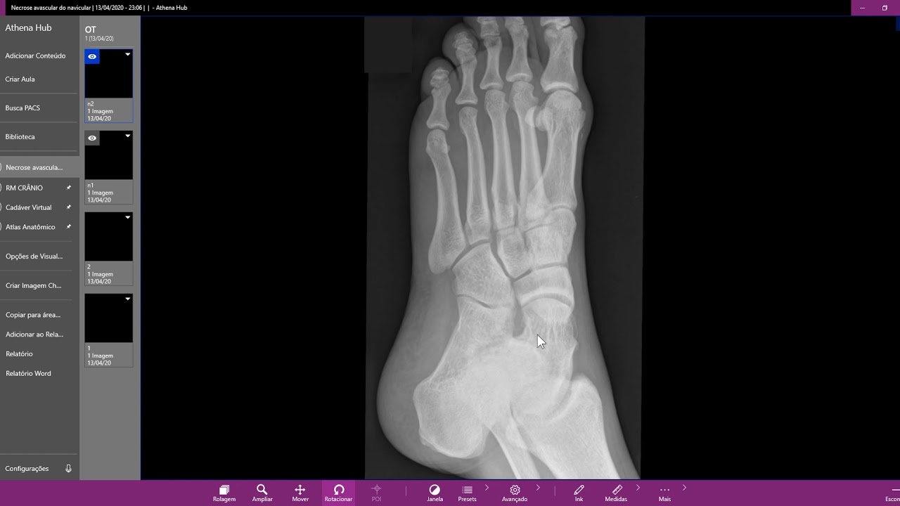 Necrose avascular do navicular