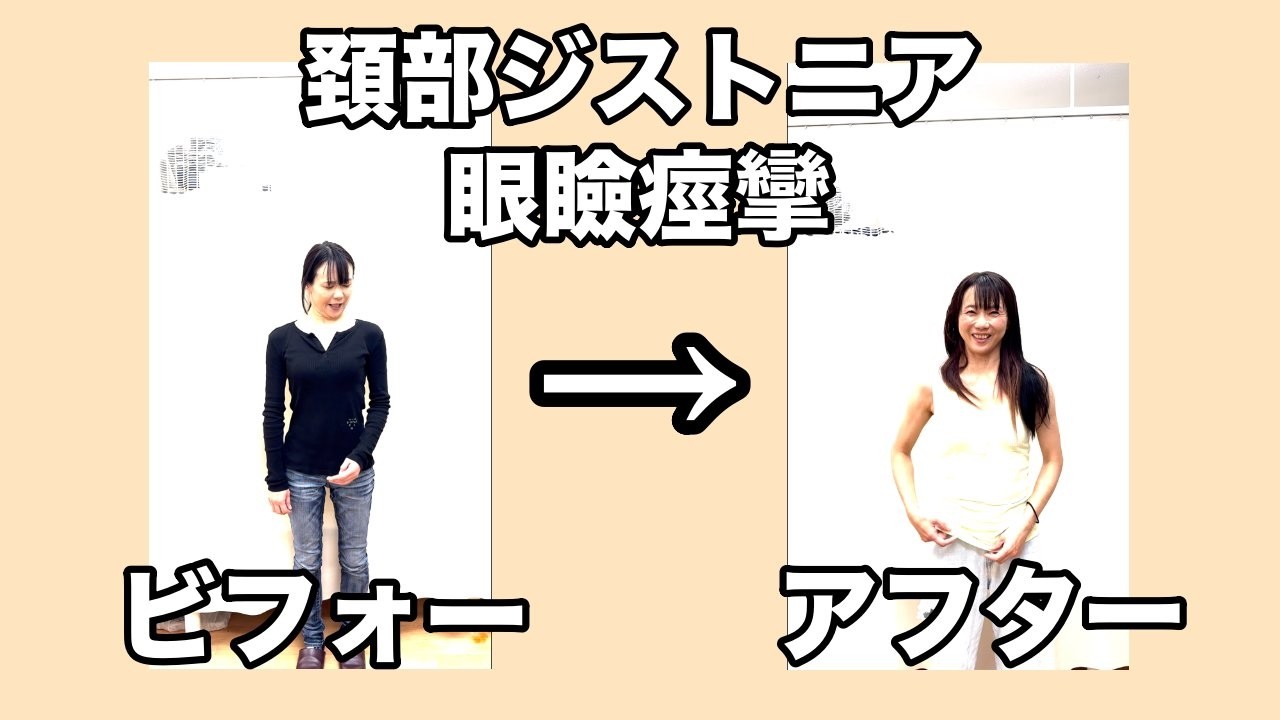 痙性斜頸(頚部ジストニア)と眼瞼痙攣と診断された女性の症状改善動画