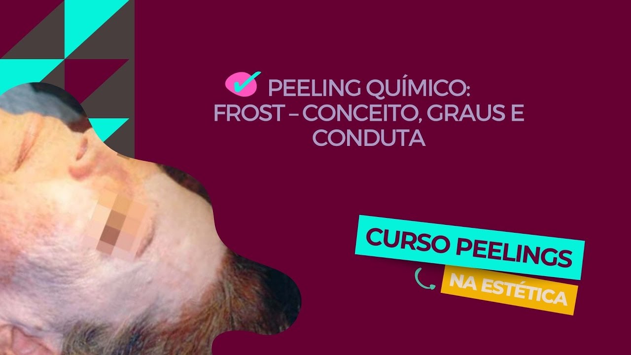 Peeling Químico: Frost [Aula 23: Curso de Peelings na Estética]