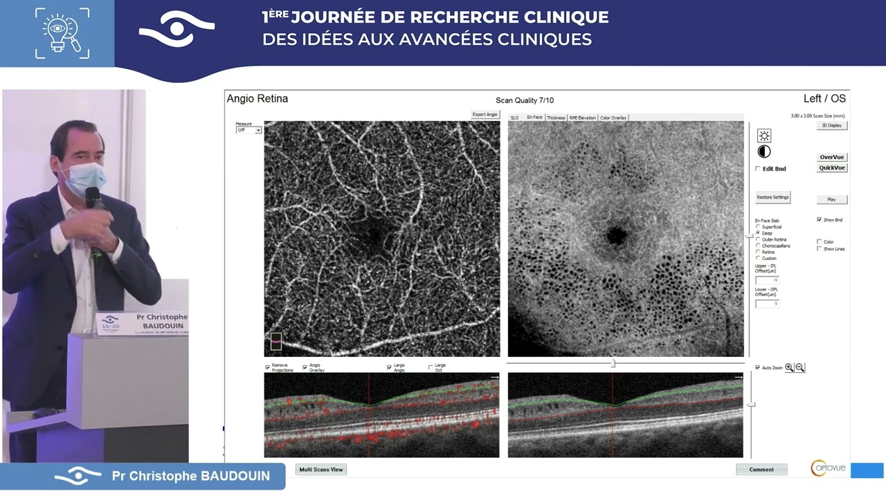 La révolution de l’imagerie du nerf optique