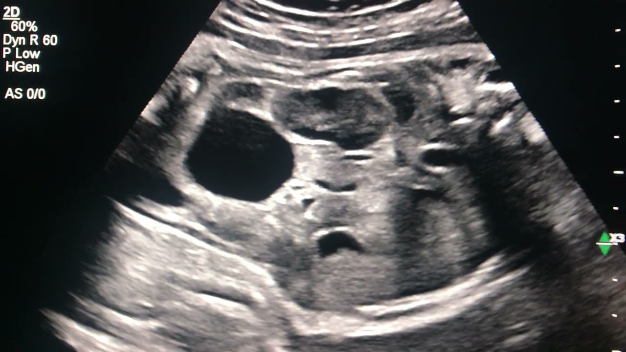 interesting case 61- OB US - .Absent LT KID. &  a Cyst