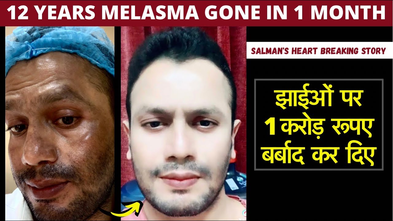 Salman’s 12 years old Melasma gone in a month. He wasted ₹1Crore on the Melasma Treatment.