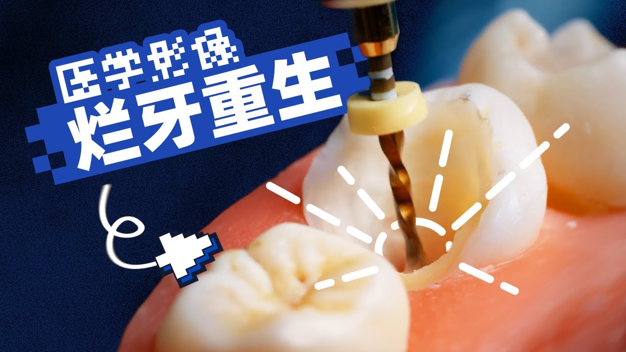 内有大矿！超近距离拍龋齿修复，隔着屏幕看痛了？！