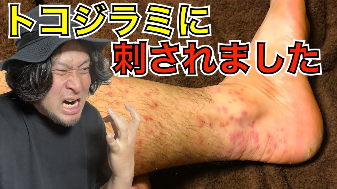 【経験者が語る】トコジラミに刺されるとマジで地獄なんです【南京虫/ベッドバグ/チュクェービーラー】