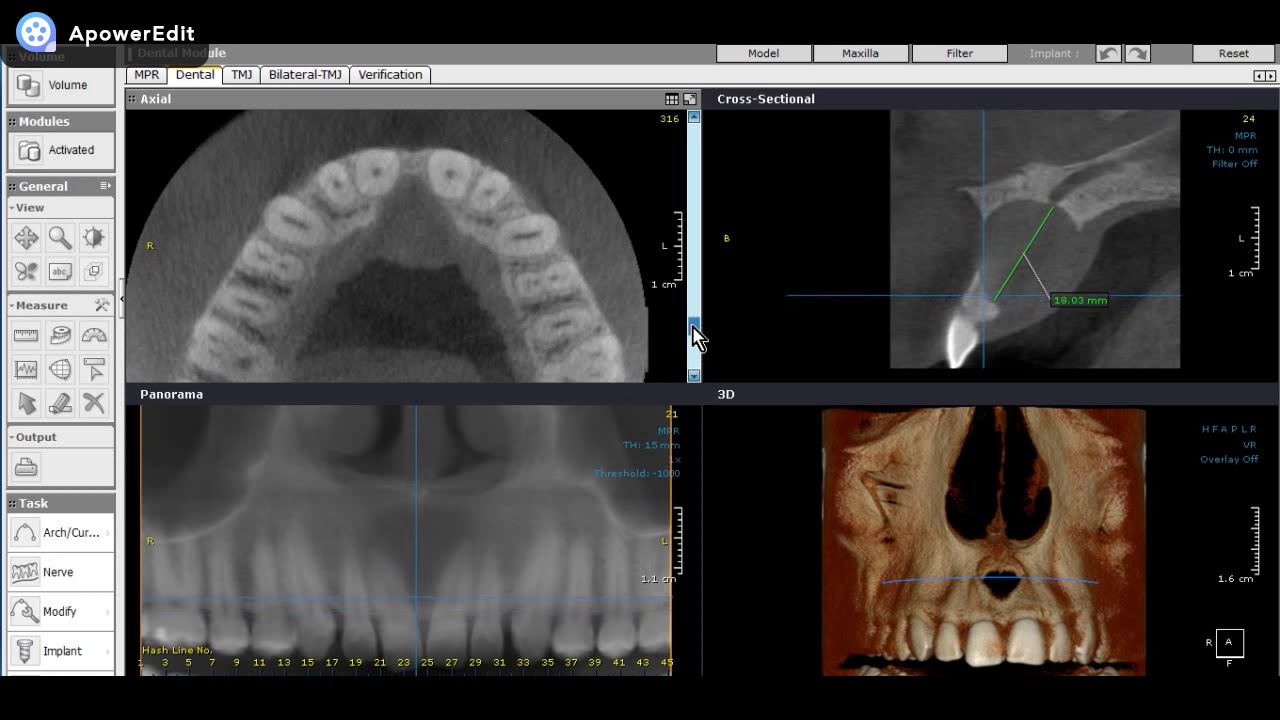 Avaliando TCFC: Cisto do Ducto Nasopalatino