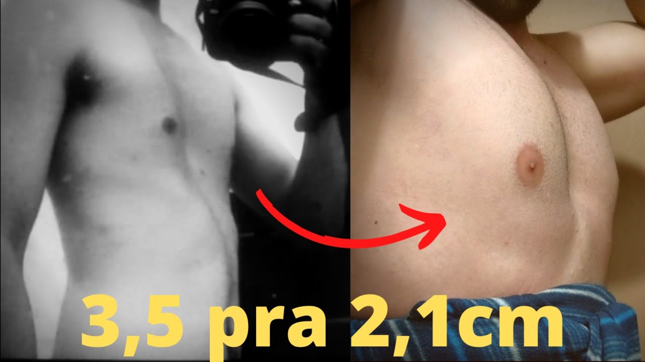 Exercício para DIMINUIR a profundidade do PECTUS EXCAVATUM e melhorar as costelas