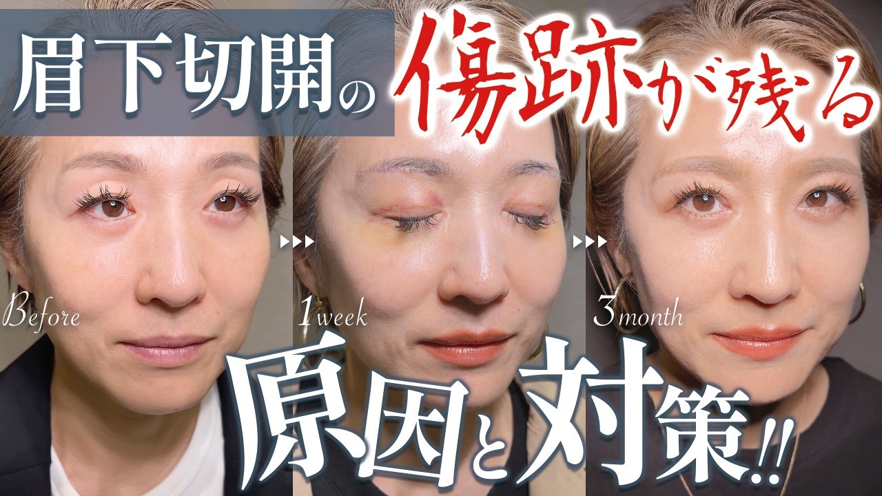 【眉下切開】「傷跡は残る？！」という疑問にDr.詩音が答えます《やる前に必ず見て❗️》